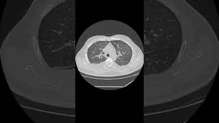 Bilateral pleural effusion [upl. by Warrenne]