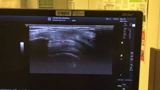 Subacromial Subdeltiod Bursa injection SASD [upl. by Zacharias]