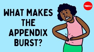 What does appendix pain feel like  David R Flum [upl. by Yelkao]