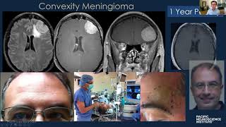 Keyhole Meningioma Removal with Dr Daniel Kelly [upl. by Resor482]