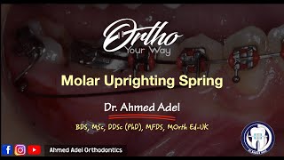 Molar upright spring Wire Bending  Orthodontics [upl. by Letsyrhc]