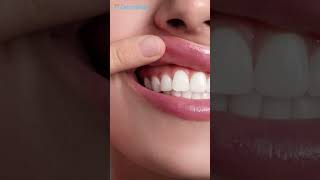 Gingival Hyperpigmentation dental ytshorts dentalkart [upl. by Havens]