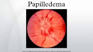 Papilledema [upl. by Ynnep]