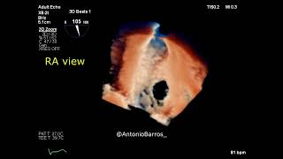 Ostium secundum ASD amp Atrial septal aneurysm  3D echocardiography [upl. by Gore]