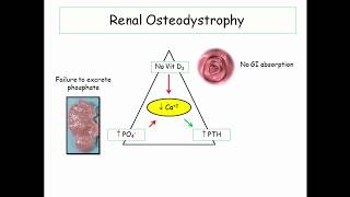 12DaysinMarch Renal Osteodystrophy for the USMLE Step One [upl. by Cianca]