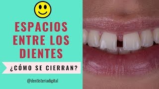 Las Resinas dentales ¿ Qué son y para que nos sirven [upl. by Noterb]