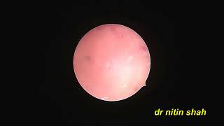 Hysteroscopy for hematometra drainage due to cervical asherman by dr nitin shah [upl. by Annaeel584]