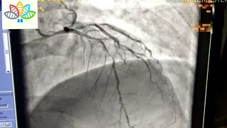 Coronary angiogram in cardiac catheterization procedures [upl. by Latreese509]