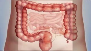 Colitis sintomas causas tratamiento [upl. by Parcel]