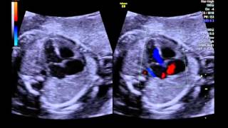 Tetralogy of Fallot 4 vessel view with colour Doppler [upl. by Viafore]