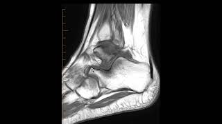 Calcaneonavicular coalition and OCD talar dome [upl. by Enellij]