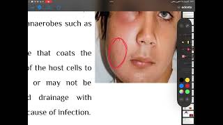 Odontogenic infections4th stage oral surgery part2 [upl. by Lehman]