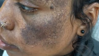 Birth mark क्यों होता है क्या ठीक हो सकता है कितना खर्चा कहां और कितनी बार करवाना पड़ेगा। [upl. by Enirrok]