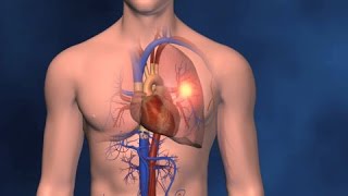 Embolism Pulmonar y TVP [upl. by Gibun909]