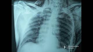 Subcutaneous Emphysema Chest X Ray [upl. by Bertine959]