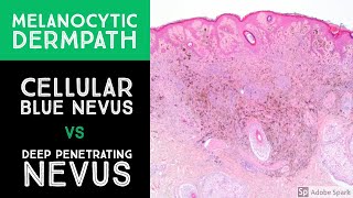 Melanocytic Dermpath Cellular Blue Nevus vs Deep Penetrating NevusMelanocytoma [upl. by Goldy919]