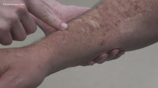 Skin Cancer How to spot melanoma warning signs [upl. by Michaeline]