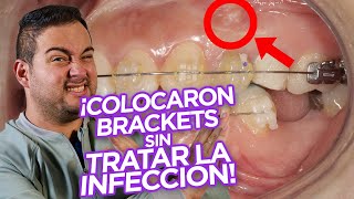 ¡BRACKETS Ortodoncia con DIENTES con ENDODONCIA TRATAMIENTOS DE CONDUCTO ¿SE PUEDE ¡CASO REAL [upl. by Assiral]