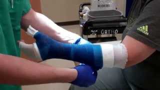 Application of a Thumb Spica Cast [upl. by Nrehtak]