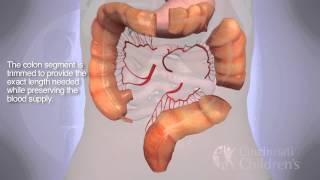 Segmental Colonic Interposition for Esophageal Atresia 3D Animation [upl. by Lebazej]