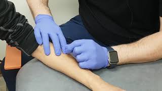 Dry Needling for Tennis Elbow [upl. by Tomchay]