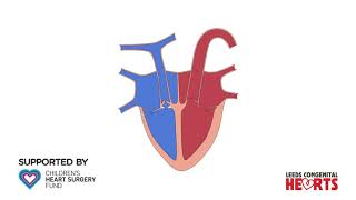 Tetralogy of Fallot [upl. by Unity]