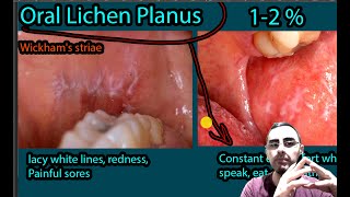 Oral Lichen Planus  Symptoms Causes Treatment Wickhams striae [upl. by Eronel]