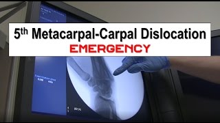 Fifth Metacarpal Dislocation and Reduction Emergency [upl. by Sal]