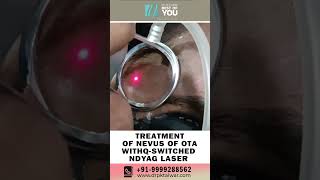 Treatment of Nevus of Ota with Laser  Birthmark Removal Treatment with Laser  Dr PK Talwar [upl. by Reginnej]