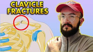 Clavicle Bone Fractures Anatomy Classification Clinical Features and Treatment [upl. by Ardnusal909]