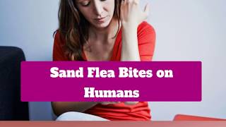 Sand Flea Bites On Humans [upl. by Loftus800]