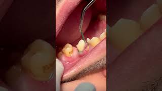 Removing retraction cord after tooth RCT amp composite restoration [upl. by Annad550]