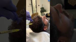 Hair PRP by Dr Rizwan Malik  MR Aesthetics  malikrizwanofficials  youtubeshort haircare [upl. by Anade]