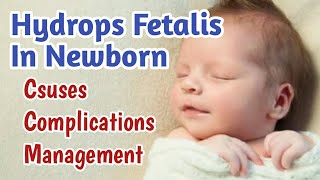 Hydrops Fetalis In Newborn Baby  Fetal Hydrops Causes Complications Treatment amp Prognosis [upl. by O'Connell]