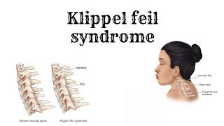 Everything about KLIPPEL FEIL Syndrome [upl. by Nwahsaj]