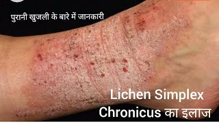 Lichen Simplex Chronicus  Lichen Planus lichenplanus pruritus itchingtreatment itchingproblem [upl. by Beauvais]