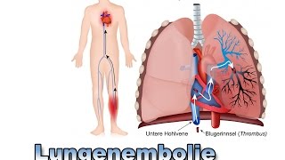 Lungenembolie  Krankheiten der Blutgefäße  Pflege Kanal [upl. by Ramunni]