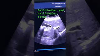 Gallbladder Stonecholelithiasis  liver and abdomen sonography abdomen ytshorts shortvideoobg [upl. by Llenad839]