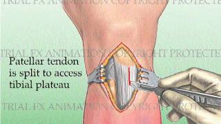 Tibial Fracture repair with Titanium Intramedullary Rod [upl. by Oflodor]