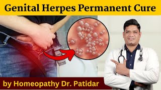 Genital Herpes Permanent Cure by Homeopathy Dr Sunil Patidar genitalherpes [upl. by Neale]