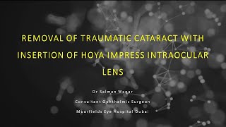 Removal of Traumatic Cataract and insertion of HOYA Vivinex Impress IOL enhanced monofocal [upl. by Dawn293]