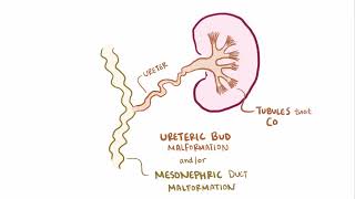 Multi cystic dysplastic Kidney  Renal pathology  Osmosis [upl. by Dieball]