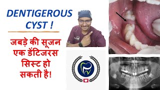 Dr Rudra Mohan  जबड़े की सूजन एक डेंटिजरस सिस्ट हो सकती है DENTIGEROUS CYST IN SIMPLE WORDS [upl. by Blackmun]