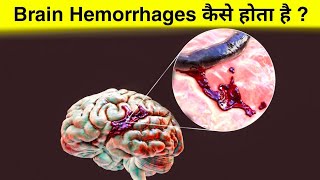 ब्रेन हेमरेज क्या है  ये कैसे होता हैं  how brain hemorrhage occurs [upl. by Attiuqaj204]