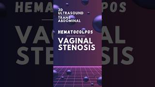 Hematocolpos  Vaginal stenosis  Transabdominal 3D ultrasonography shortsfeed [upl. by Jeconiah]