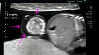 Omphalocele or exomphalos 3D ultrasound video [upl. by Yesnek]