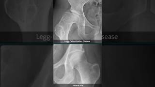 LeggCalvePerthes Disease Xray 1 [upl. by Eilrebmik]