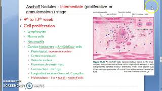 Pathology 436 c Rheumatic Fever Heart Disease Morphology AnitSchkow Aschoff Giant Nodules Bodies 2 [upl. by Allets422]