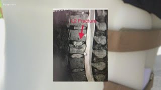 Unique procedure heals fractures in backs Austin doctors say [upl. by Jalbert]