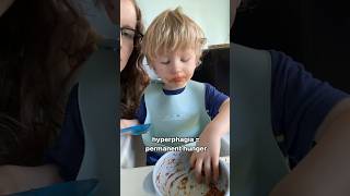 Is my toddler always hungry Let’s talk PraderWilli Syndrome [upl. by Garges]